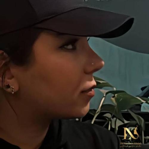 rhinoplasty-795