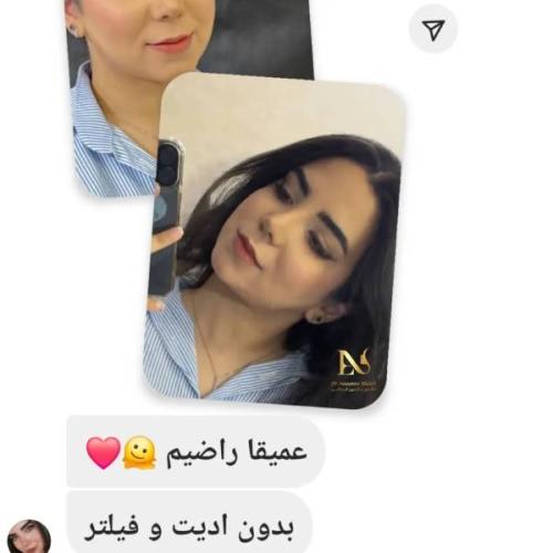 rhinoplasty-796