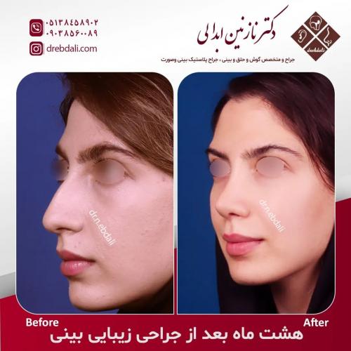 جراحی-بینی-540