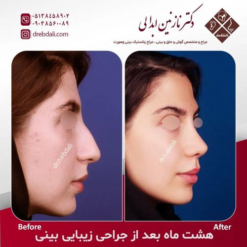 جراحی-بینی-541
