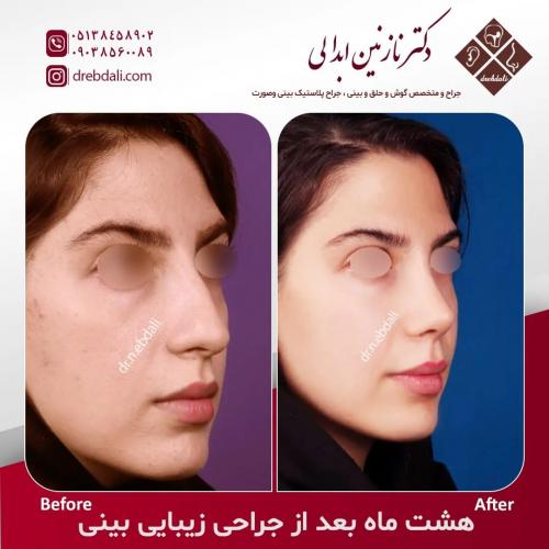 جراحی-بینی-542