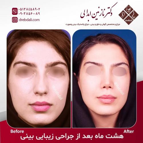 جراحی-بینی-543