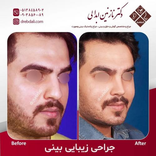 جراحی-بینی-544