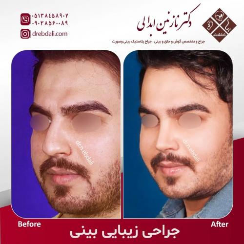 جراحی-بینی-545