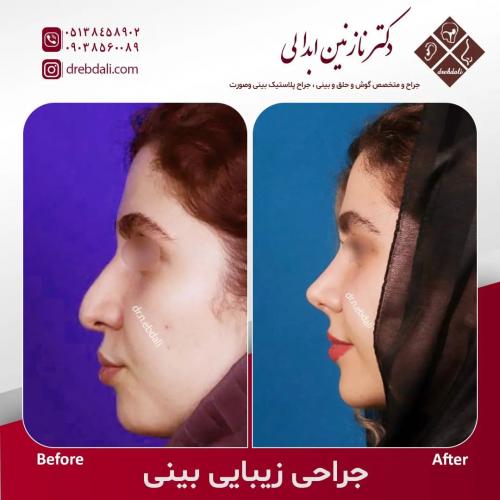 جراحی-بینی-548