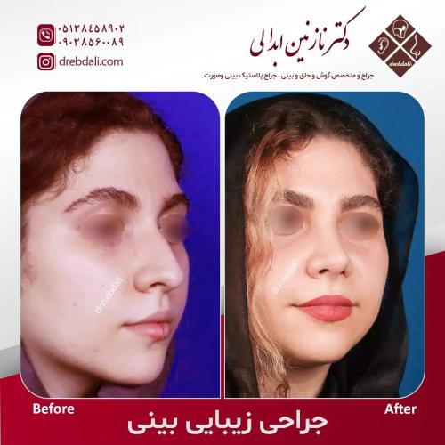 جراحی-بینی-550