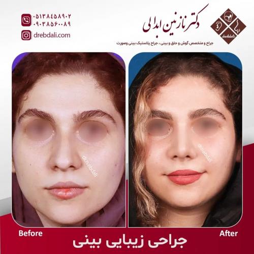 جراحی-بینی-551