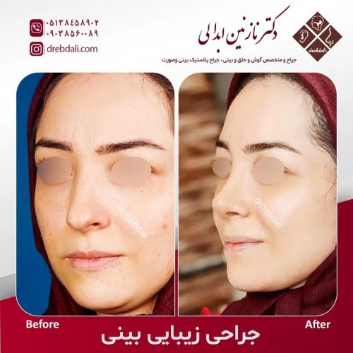 جراحی-بینی-552