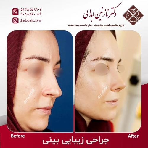 جراحی-بینی-553