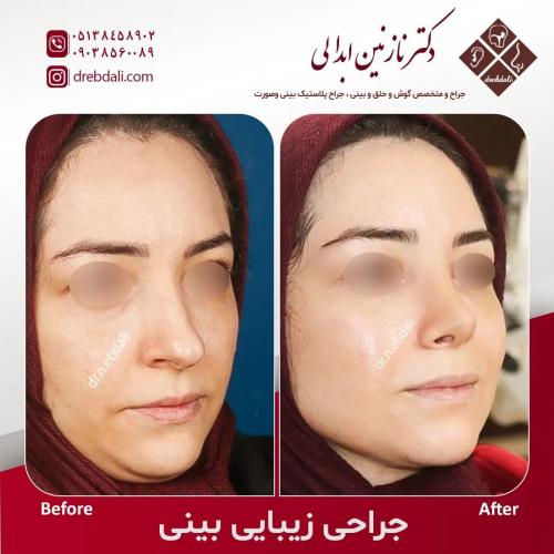 جراحی-بینی-555