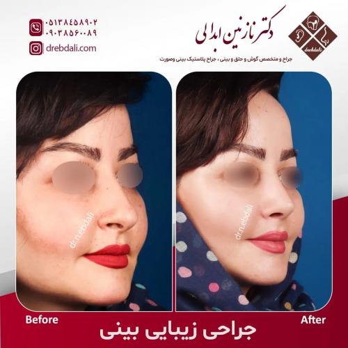 جراحی-بینی-556