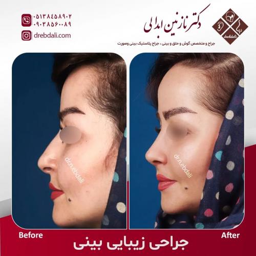 جراحی-بینی-557
