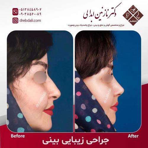جراحی-بینی-559