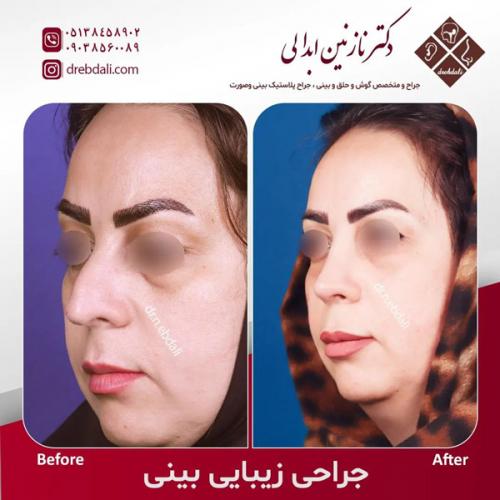 جراحی-بینی-563