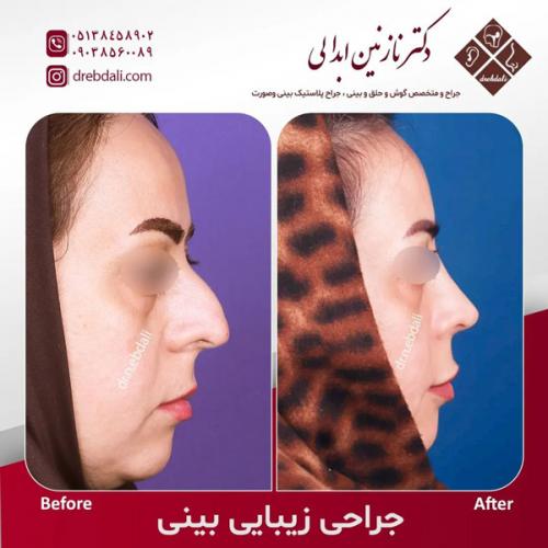 جراحی-بینی-564