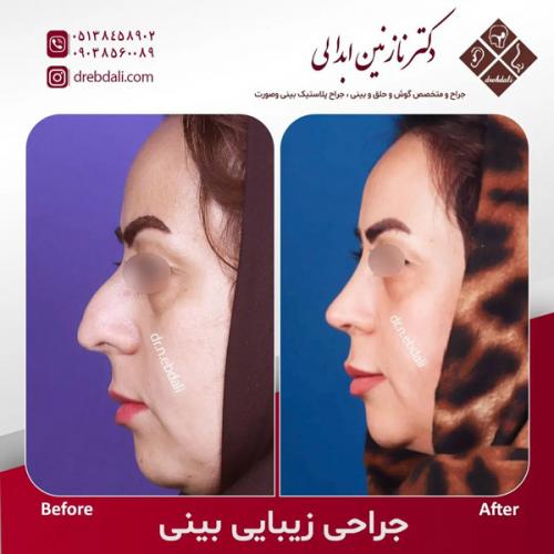 جراحی-بینی-565