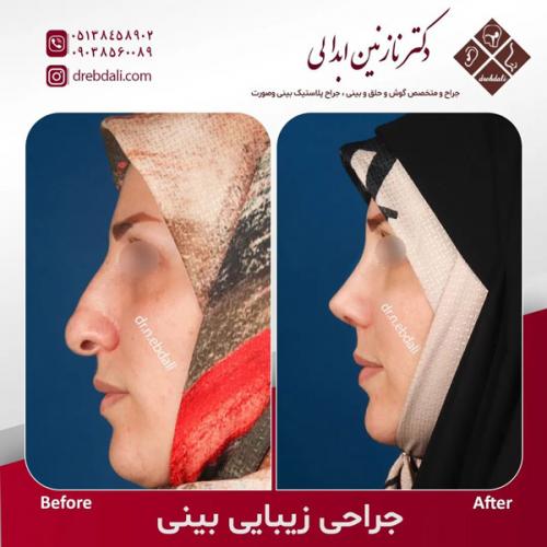 جراحی-بینی-571