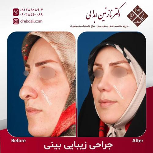 جراحی-بینی-572