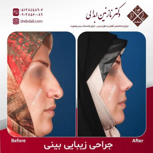 جراحی-بینی-573