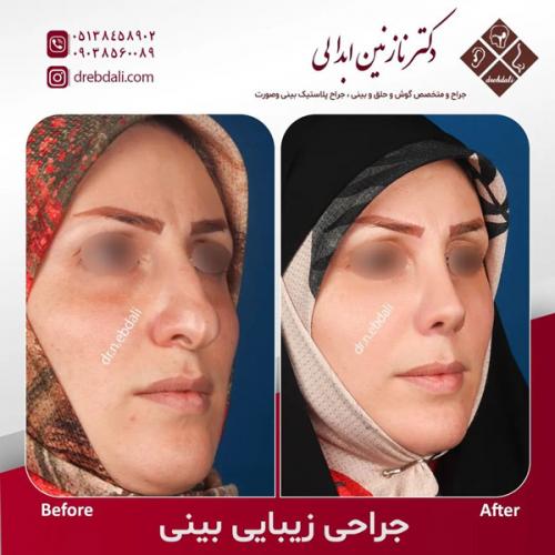 جراحی-بینی-574