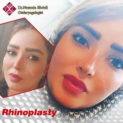 جراحی-بینی-577