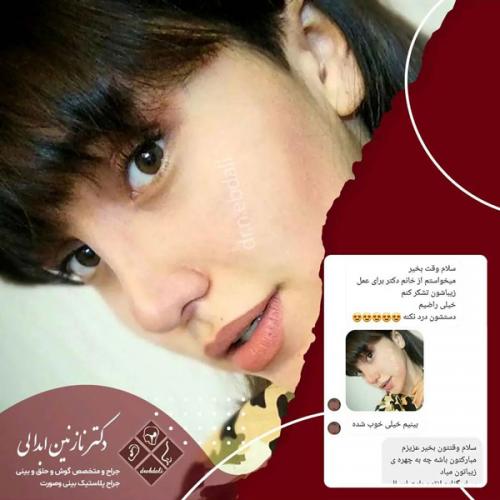جراحی-بینی-578
