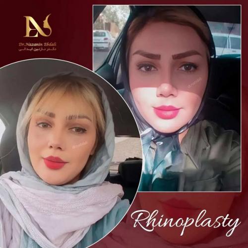 جراحی-بینی-581