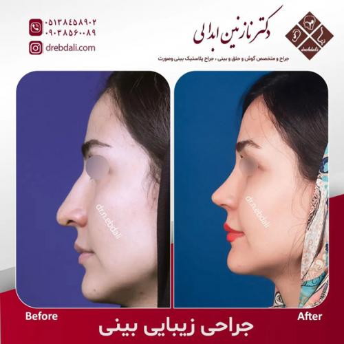 جراحی-بینی-582