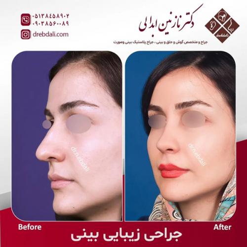 جراحی-بینی-583