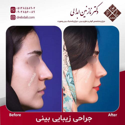 جراحی-بینی-584