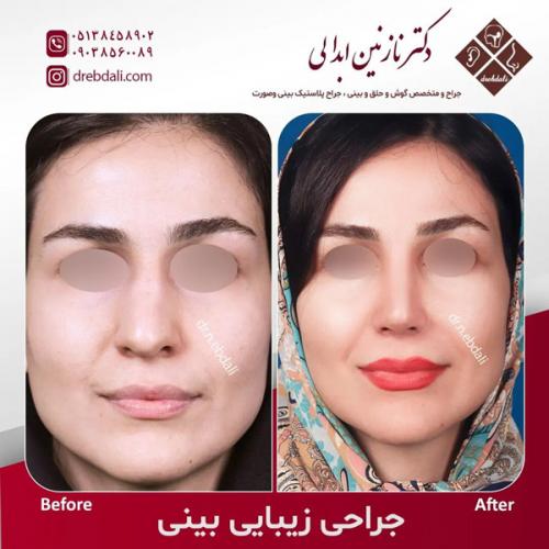 جراحی-بینی-585