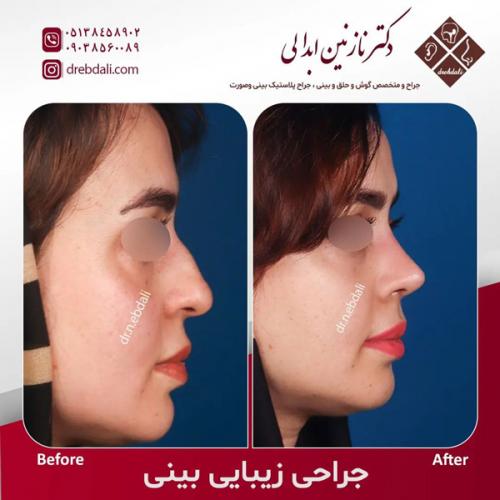 جراحی-بینی-586