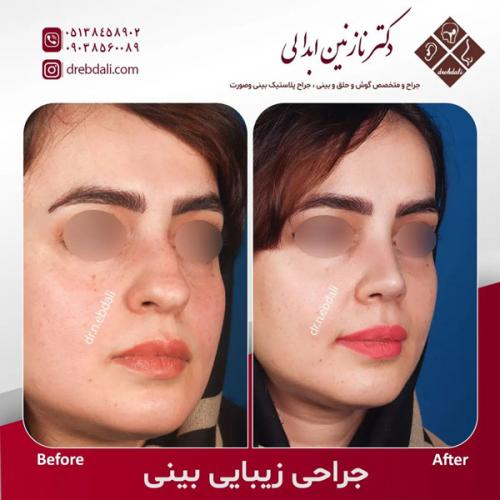 جراحی-بینی-587