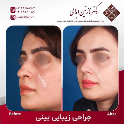 جراحی-بینی-588