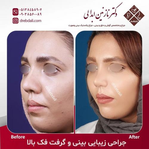 جراحی-بینی-590