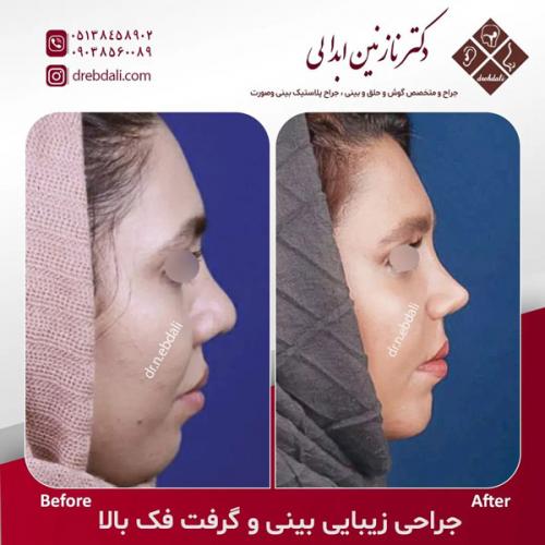 جراحی-بینی-591