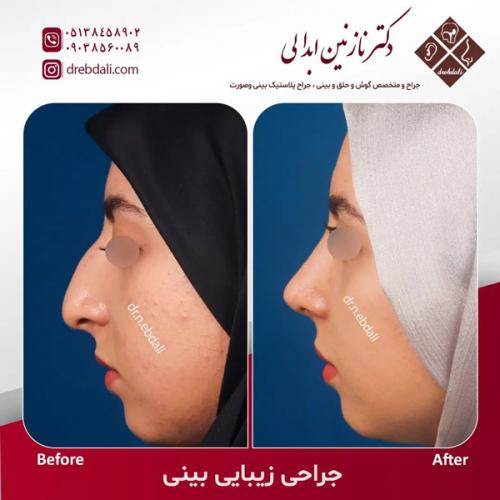 جراحی-بینی-593