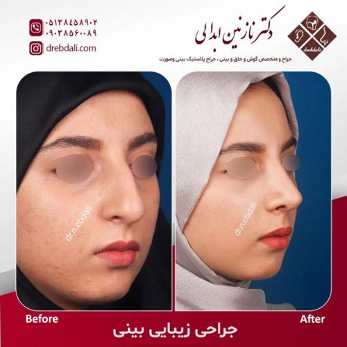 جراحی-بینی-595