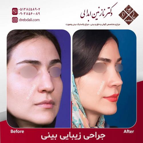 جراحی-بینی-597