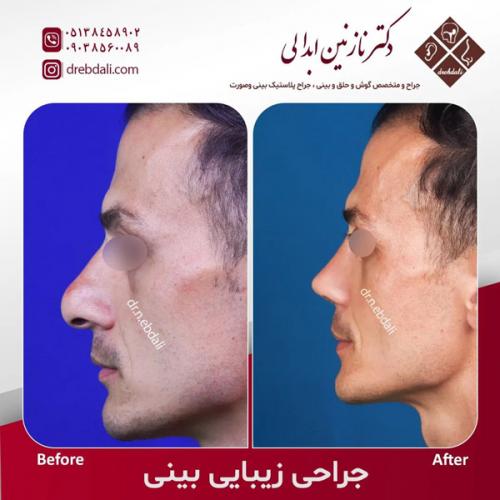 جراحی-بینی-599