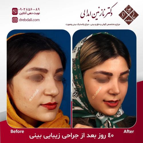 جراحی-بینی-613