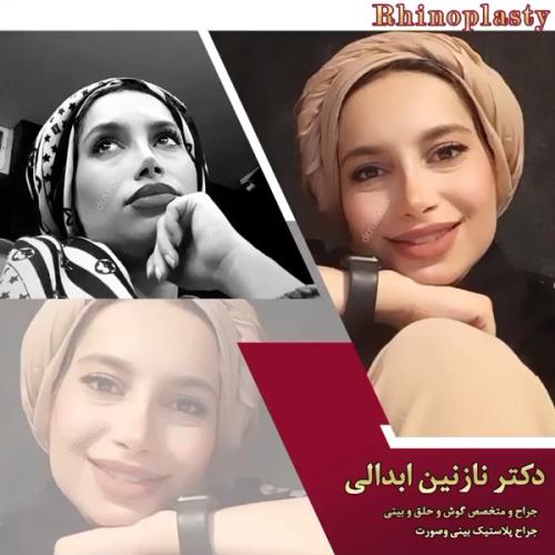 جراحی-بینی-614