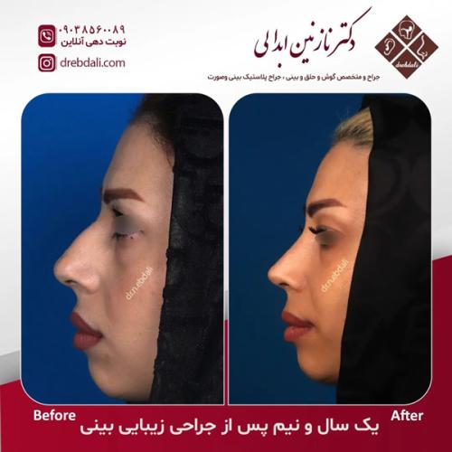 جراحی-بینی-615