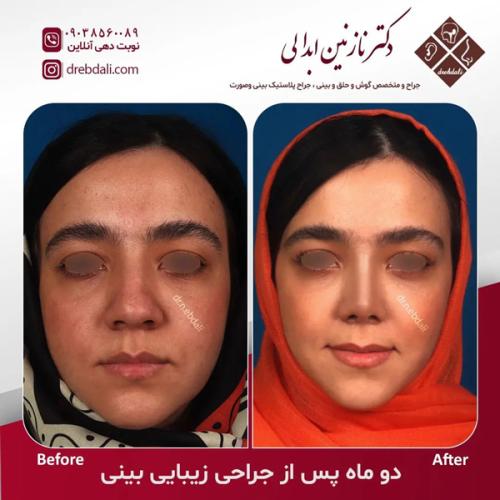 جراحی-بینی-616