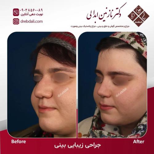 جراحی-بینی-621