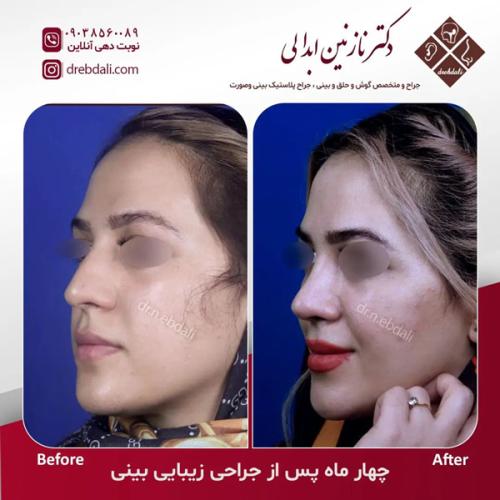 جراحی-بینی-622