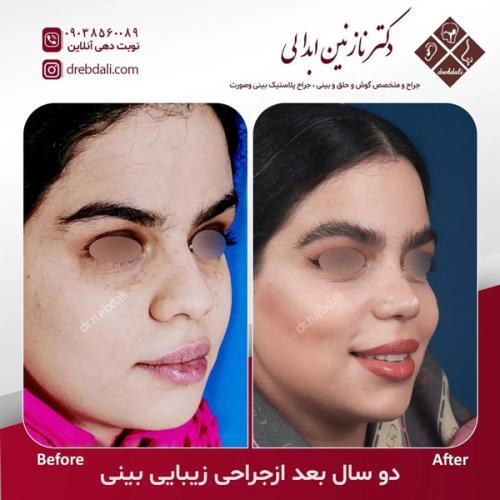 جراحی-بینی-623