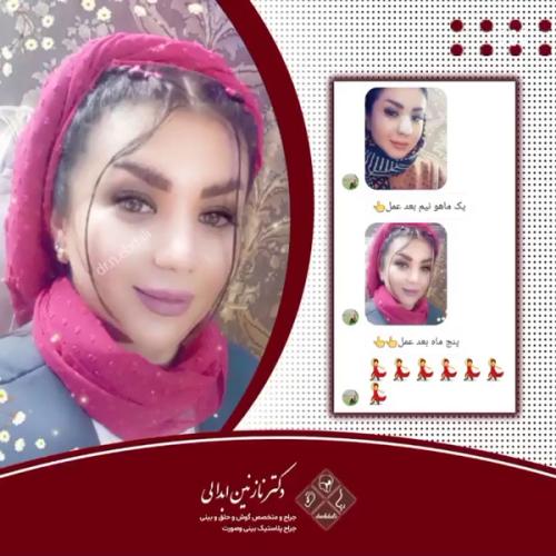جراحی-بینی-625