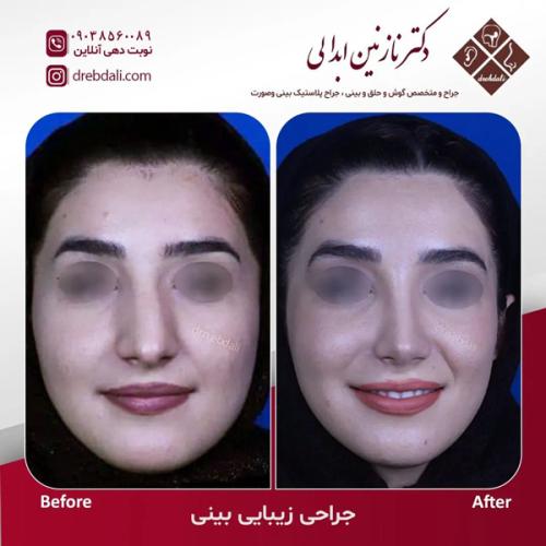 جراحی-بینی-627
