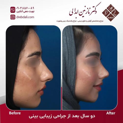 جراحی-بینی-632